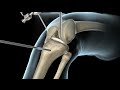 Knee Surgery | Torn ACL | Nucleus Health