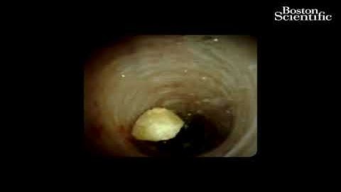 LCBDE with digital choledochoscopy and electrohydraulic lithotripsy (no narration)