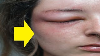 how to get rid of face swelling fast at home