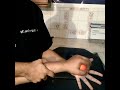 Hand rehabilitation after stroke