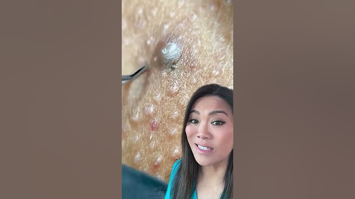 We call this a “collision pop”  An ingrown hair next to a comedone 💥