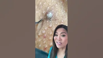 We Call This A Collision Pop An Ingrown Hair Next To A Comedone 