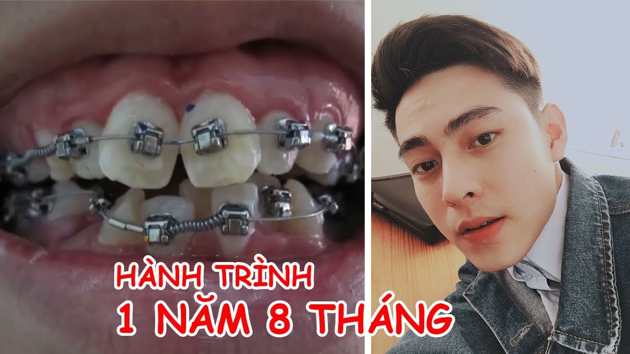 Niềng Răng Đẹp Thế Nào ? Hành Trình 1 Năm 8 Tháng |... - youtube