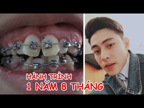 Video Niềng Răng Đẹp Thế Nào ? Hành Trình 1 Năm 8 Tháng |... - youtube