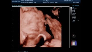 4D/5D SonoBee Ultrasound baby scan #5dScan