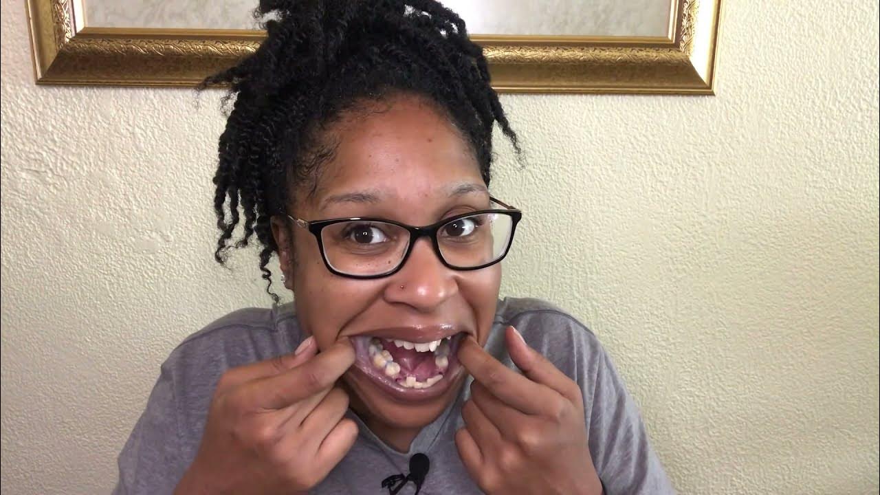ADULT BRACES VLOGI I GOT 4 TEETH EXTRACTED AND SPACERS FOR BRACES ON