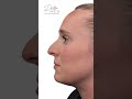 15-Minute Non-Surgical Nose Job 🔥