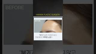 딱딱하게 남은 이마 필러, 초음파 유도 히알라제 시술로 해결!