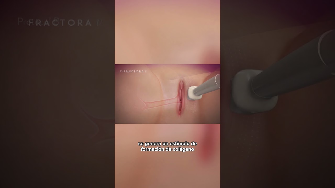 Morpheus 8 Forma V - Dr. Angélica Domínguez Dermatóloga en bogotá