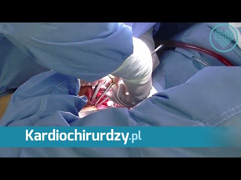Wideo: Zwężenie Zastawki Aortalnej I Zastawki Serca