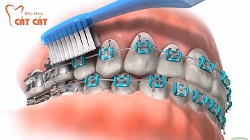 Hướng dẫn chăm sóc răng miệng khi chỉnh nha | Nha khoa Cát Cát