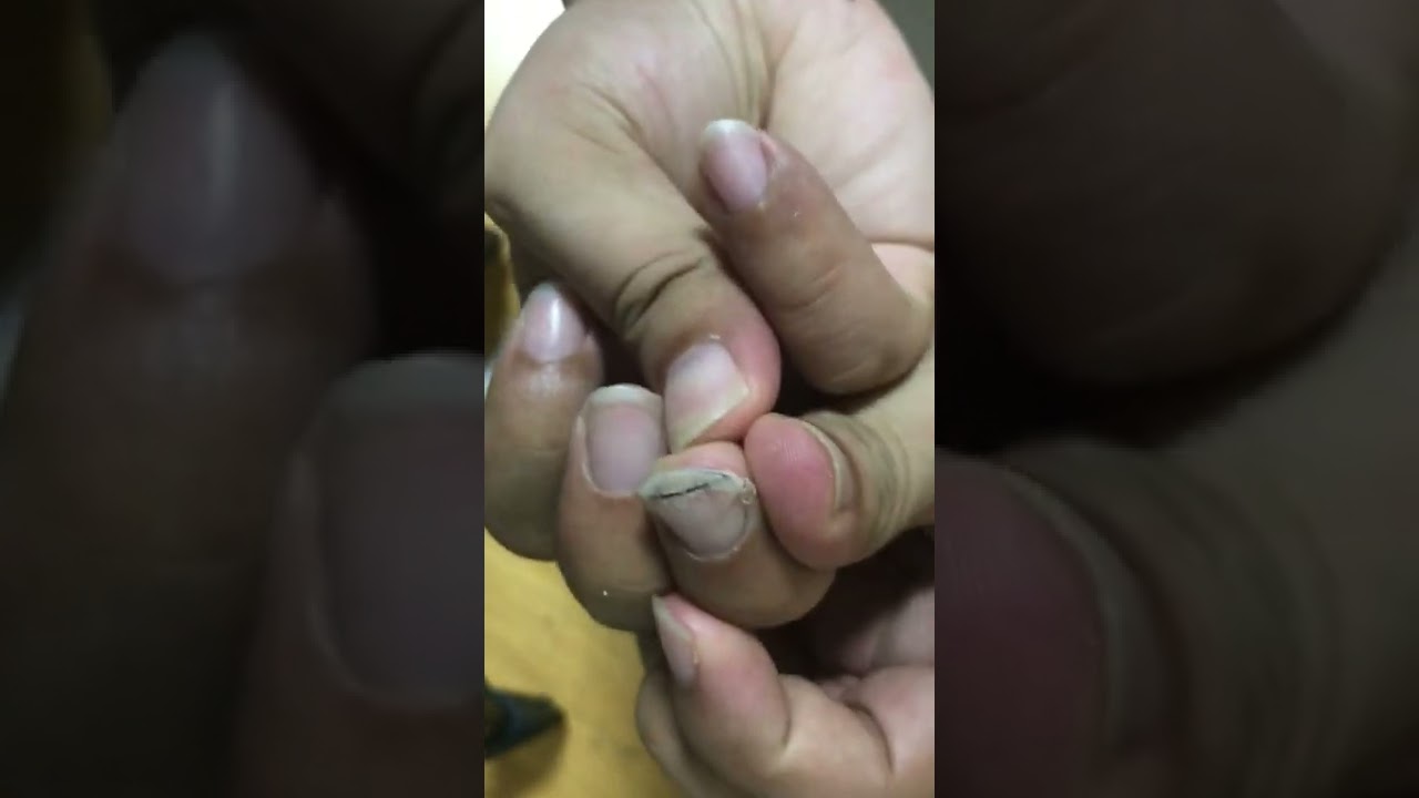 巻き爪　ささなかとおるくん　1100円で巻き爪は治る。爪は医療保険適応外ばっかなので自分で対策治せた方がいいですよね。