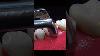 Incredible Dental Implant Procedure - Explained Step By Step