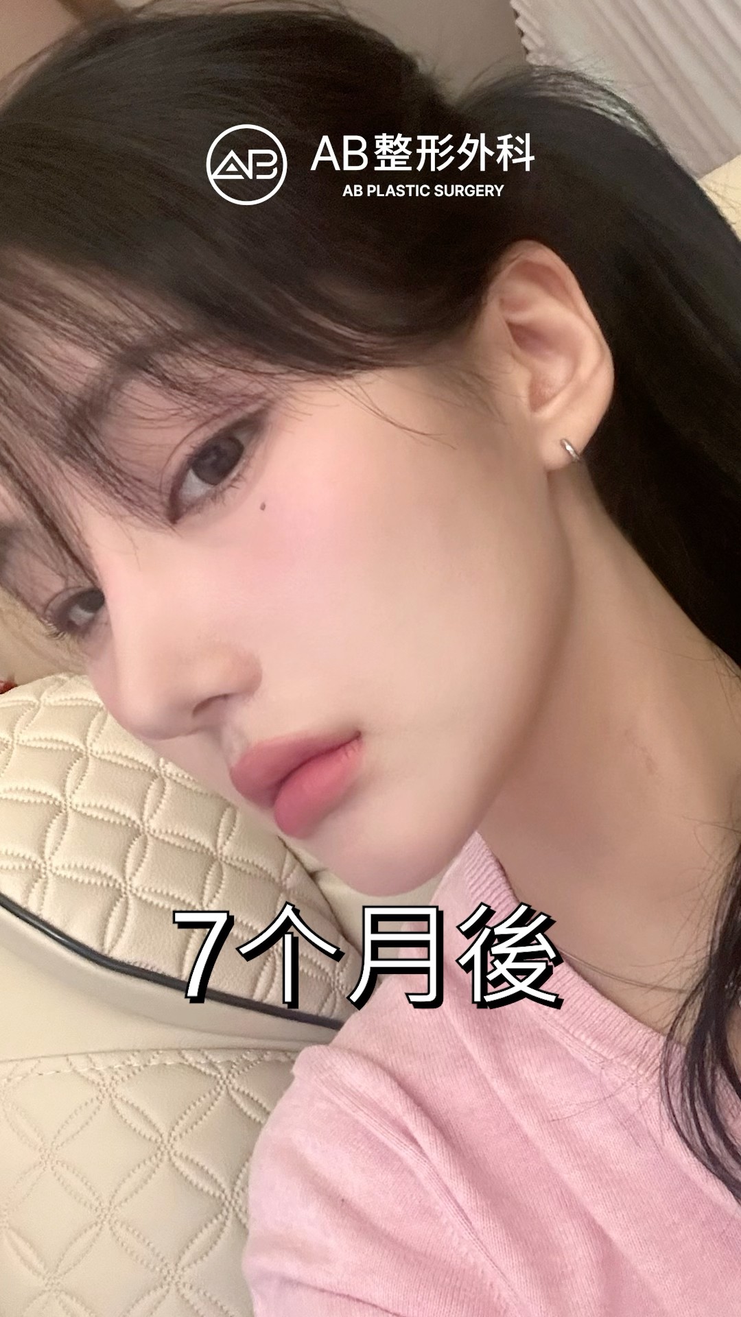 韓式整形實力…眼鼻改變整張臉 #shorts