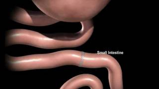 腹腔鏡胃繞道手術 (Laparoscopic Gastric Bypass)