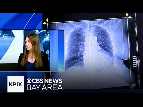 In Focus: Lung cancer in Asian American women