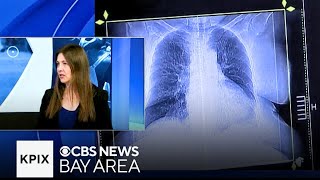 In Focus: Lung cancer in Asian American women