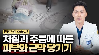 😉중년성형 안면거상술! 증상(나이)에 따른 근막, 피부 당기기의 차이점【에이징엘】