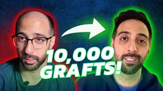 INSANE 10,000 GRAFT TURKEY HAIR TRANSPLANT RESULTS | 6 Months Later...