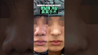 Chill Guy도 놀랄 자연스러운 콧날개 거상  #코성형#콧날개거상 #코재수술 #beforeandafter #콧볼축소