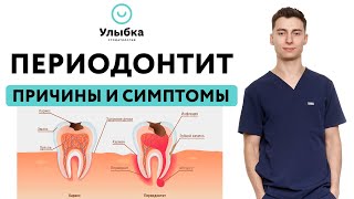 Симптомы Периодонтита. Острый и хронический периодонтит зуба у детей и взрослых