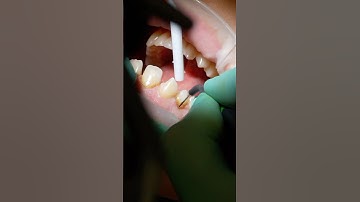 Veneers Mock Up + Gingivectomy #Veneers #Gingivectomy #MockUp