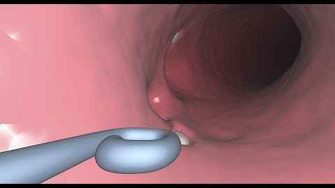 Intravascular Pigtail Catheter Navigation for Cardiac Surgery (ERGOSURG GmbH, Ismaning, Germany)