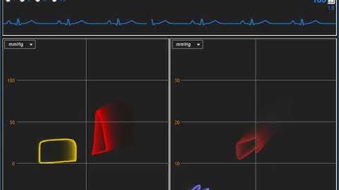 PVloops VAECMO and Impella (Donker DW et al)