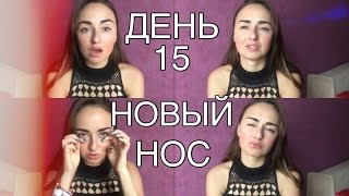 РИНОПЛАСТИКА ДЕНЬ 15/ ЧТО С НОСОМ???+ ЛИЧНЫЕ ИСТОРИИ РИНОПЛАСТИКА ДЕНЬ 15/ ЧТО С НОСОМ???+ ЛИЧНЫЕ ИСТОРИИ