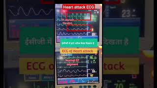 ECG of Heart attack | ECG trending youtubeshorts heartattack ECG shortsvideo  trending viral