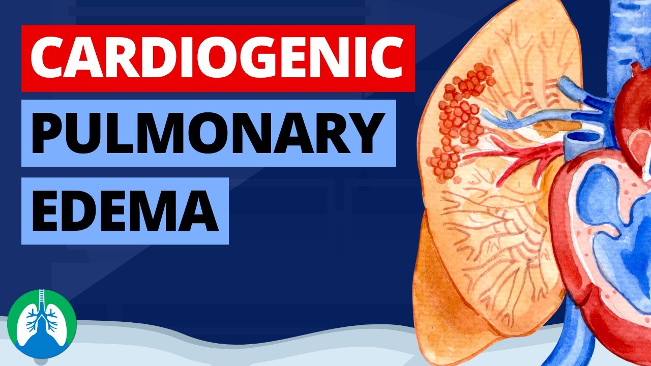 Cardiogenic Pulmonary Edema Medical Definition Quick Explainer Cardiogenic Pulmonary Edema Medical Definition Quick Explainer