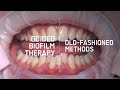 Guided Biofilm Therapy VS Old Hygiene Treatment
