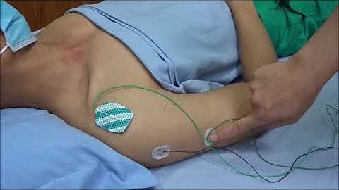 7 Dây TK mũ vận động Axillary Motor