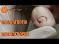 Onicoatrophy and subungual blister #podology #asmr