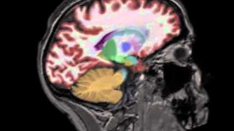 Neuroquant and Dynasuite MRI Processing