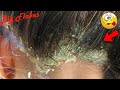 Dandruff Scratching Dry Flakes Popping # 900