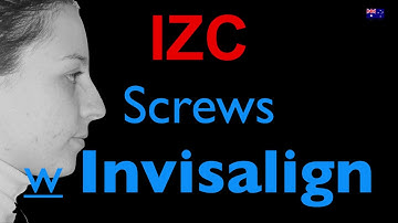 protocols to solve a severe Class II with invisalign and Screws