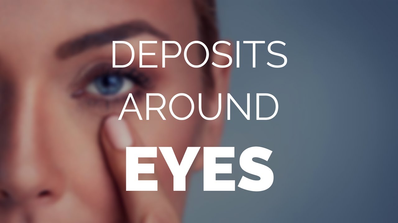 Deposits around eyes and how to easily remove them ! YouTube