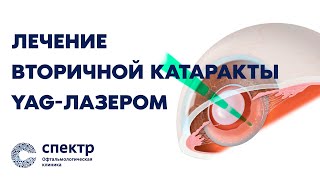 Вторичная катаракта - катаракта после замены хрусталика. Почему возникает и что делать?