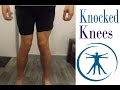 How To Fix Knocked Knees (Genu Valgum) With Correction Exercises