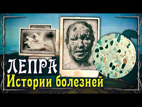 Лепра. Пожизненная ссылка, смерть в мучениях, нищете и забвении