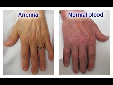 start-eating-more-iron-right-away-if-you-experience-any-of-these-10-signs-of-anemia