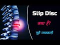 What is Slip Disc with Full Information? – [Hindi] – Quick Support