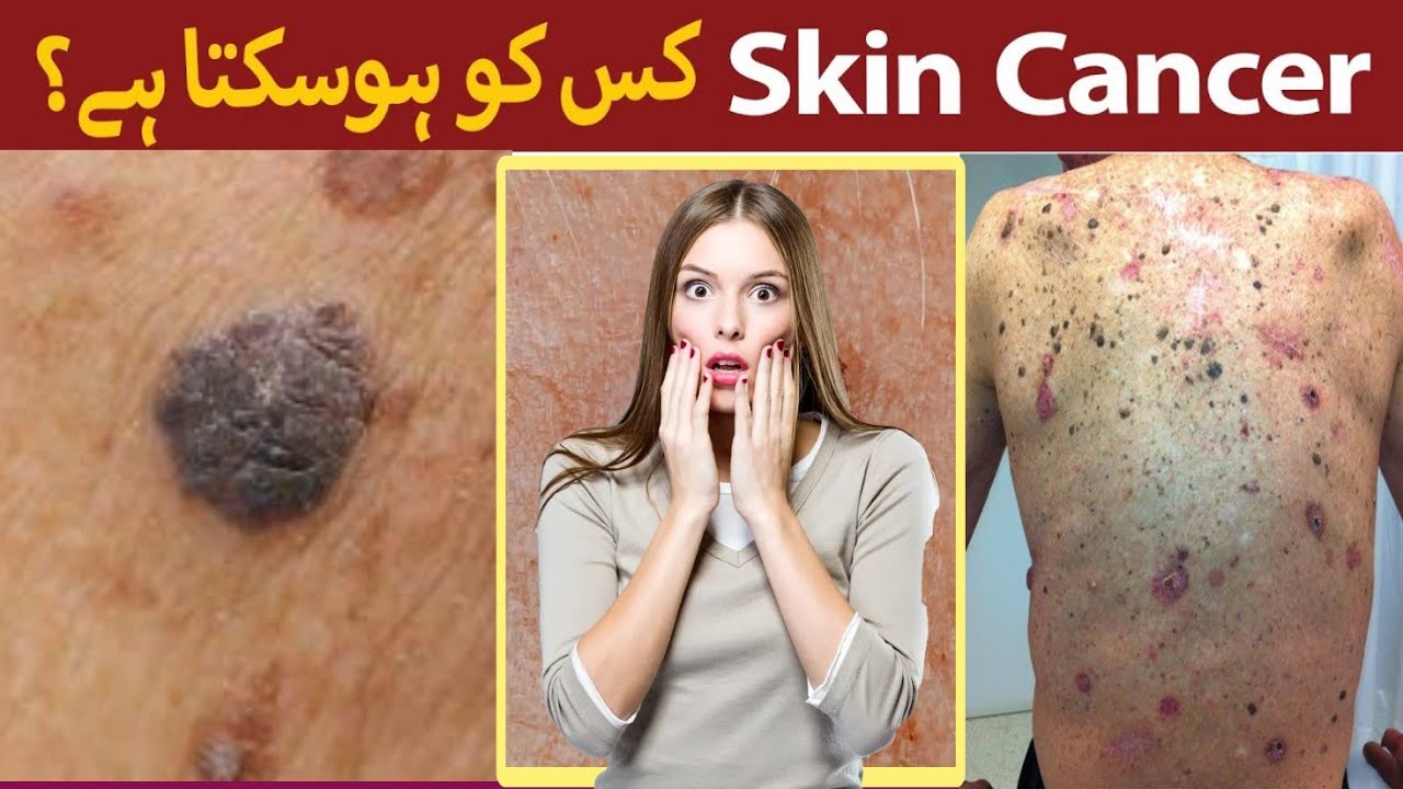 Skin Cancer Kaise Hota Hai Skin Cancer Ki Alamat Melanoma Skin
