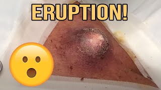 Speedy's Tough Back Cyst w/ Follow Up - Top Videos #38