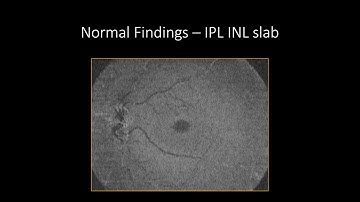 Structural EnFace OCT course - Normal findings and Artifacts