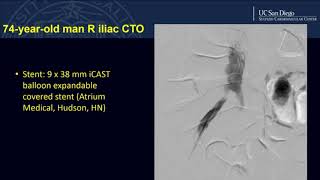 Use of the Ocelot Catheter in Iliac CTO Intervention - Daniel Walters, MD
