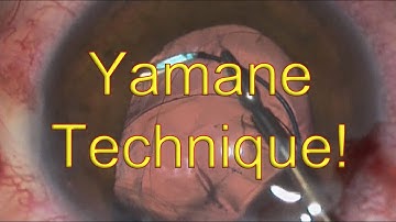 Yamane technique for dislocated IOL: Intrascleral Haptic Fixation - Dr Simon Chen