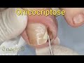 Unha encravada tem nome?? Descubra o que é uma ONICOCRIPTOSE #satisfying #nails