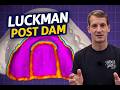 The Luckman Post Dam Technique (Digital Workflow In Exocad) | Overview of Technique